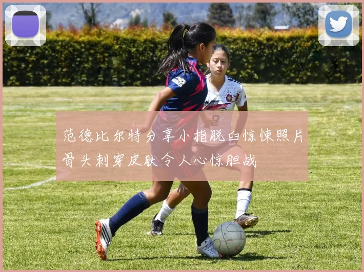 范德比尔特分享小指脱臼惊悚照片骨头刺穿皮肤令人心惊胆战
